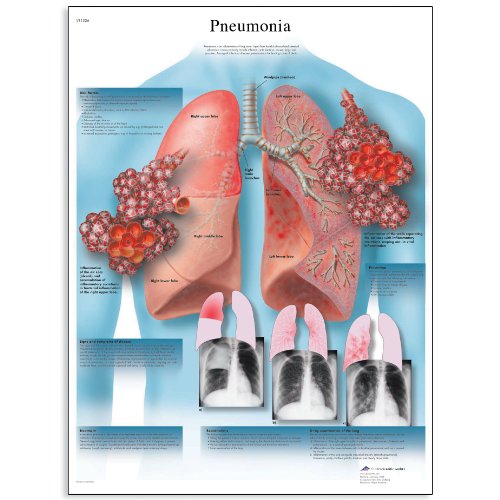 3b-scientific-lungenentz-ndung-schaubild-anatomie-poster-50-x-67-cm-200-g-glanz image 3