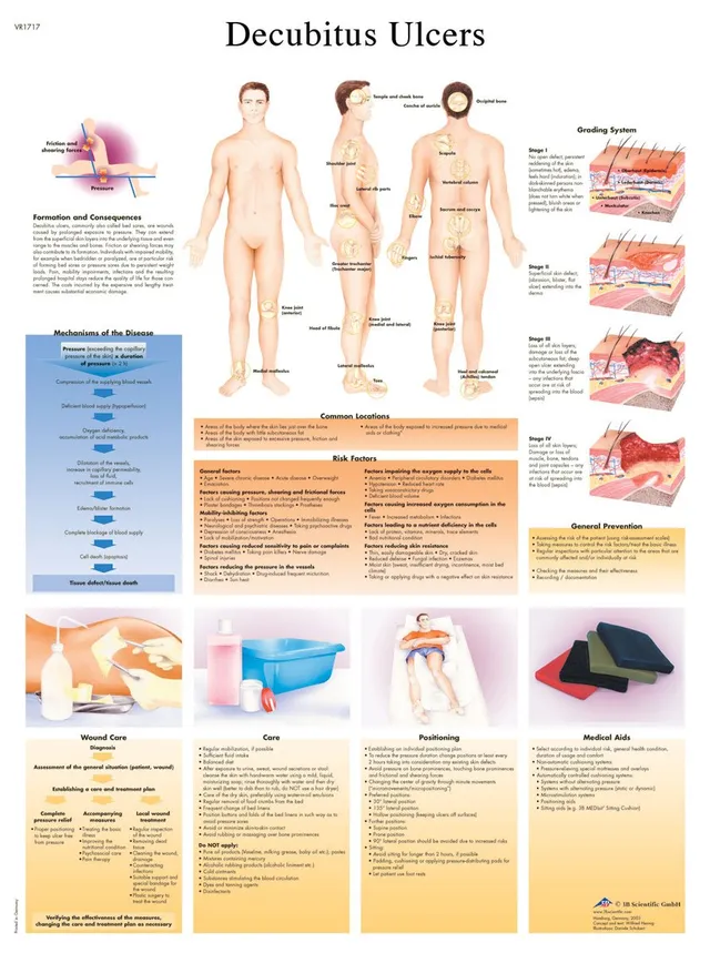 3b-scientific-lehrtafel-dekubitusgeschw-re-laminiertes-pathologie-poster-50-x-67 image 1