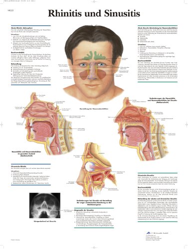 3b-scientific-lehrtafel-rhinitis-und-sinusitis-laminiertes-anatomie-poster-50x67 image 2