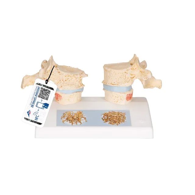 3b-scientific-osteoporosemodell-brustwirbel-vergleichsmodell-gesund-vs-osteoporo image 1
