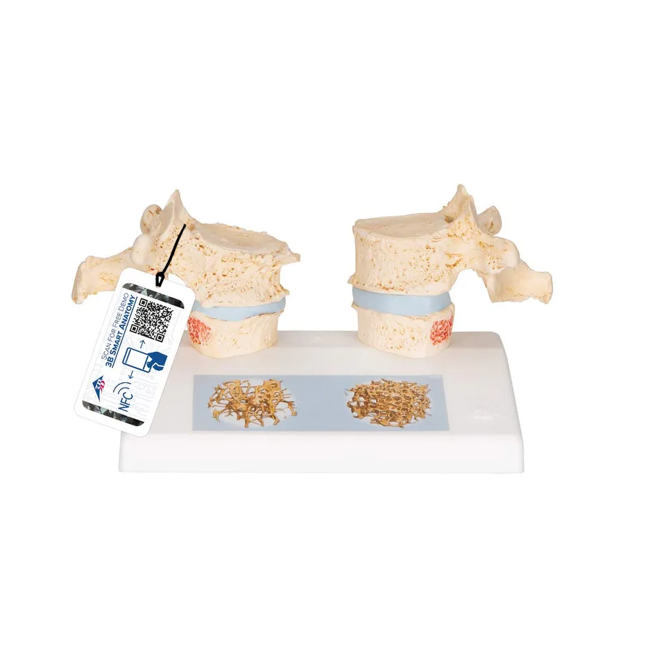 3b-scientific-osteoporosemodell-brustwirbel-vergleichsmodell-gesund-vs-osteoporo image 1