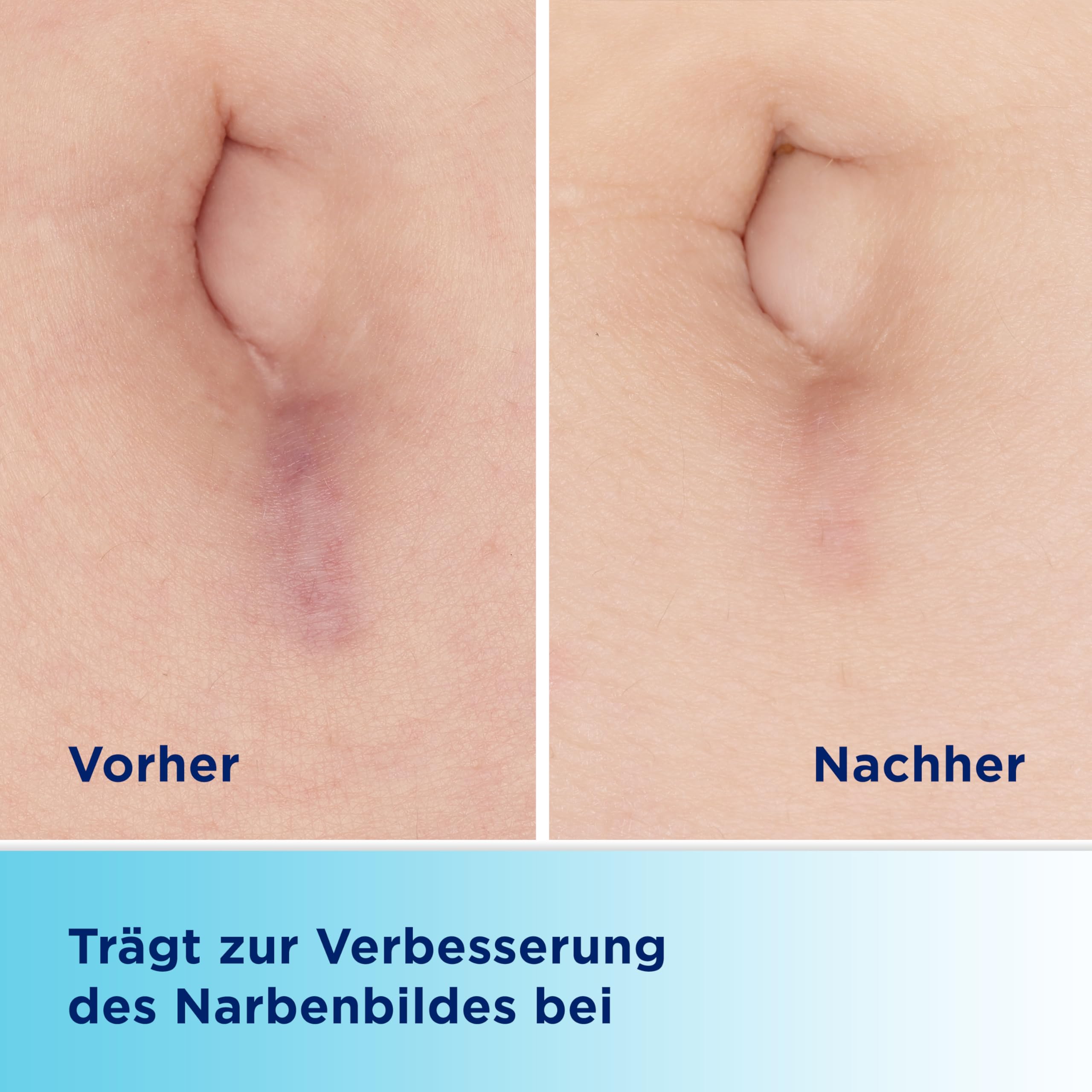 bepanthen-bepancare-narben-gel-20g-silikon-gel-mit-dexpanthenol-und-massage-roll image 3