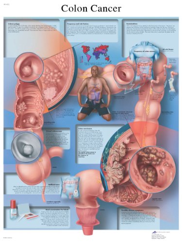 3b-scientific-lehrtafel-darmkrebs-diagramm-50x67-cm-anatomie-poster image 4