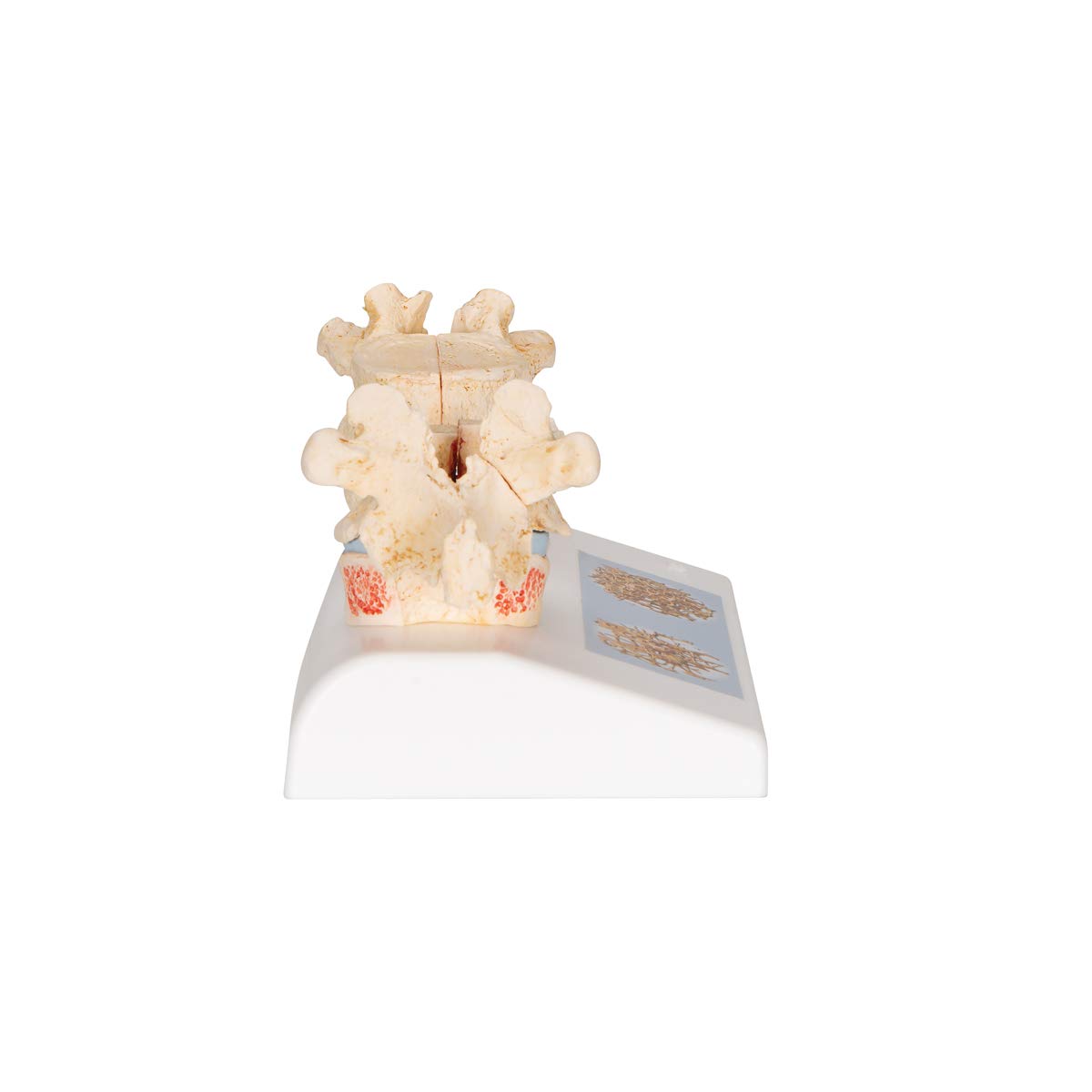 3b-scientific-osteoporosemodell-brustwirbel-vergleichsmodell-gesund-vs-osteoporo image 3