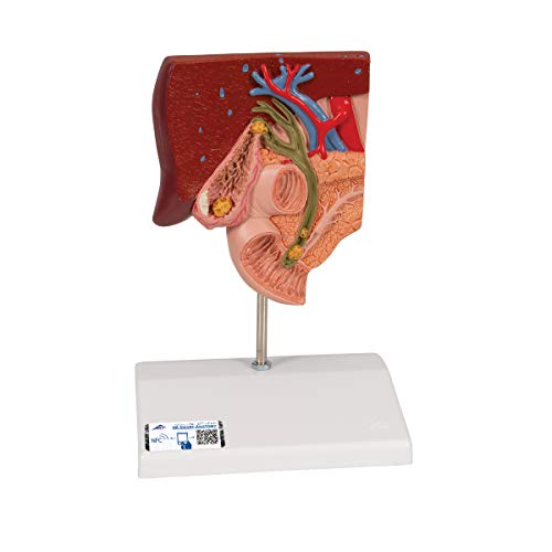 3b-scientific-gallenstein-modell-gallenblasenanatomie-mit-gallensteinbildungen-a image 6