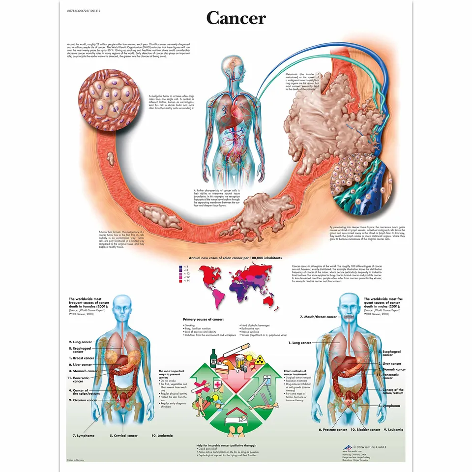 3b-scientific-krebs-anatomie-lehrtafel-cancer-chart-papierposter-50-x-67-cm image 1