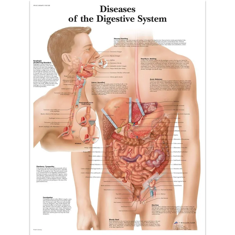 3b-scientific-krankheiten-des-verdauungssystems-laminierte-pathologie-lehrtafel- image 1