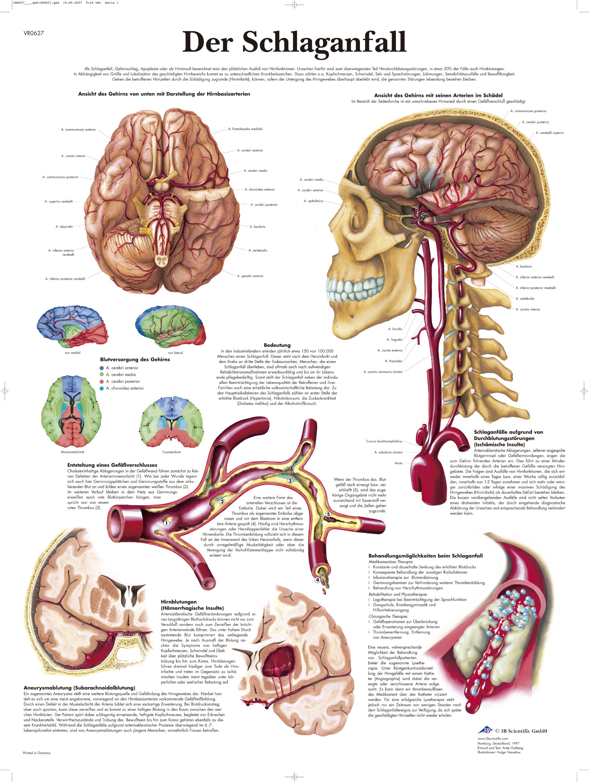 3b-scientific-lehrtafel-der-schlaganfall-anatomieposter-50x67-cm-laminiert image 1