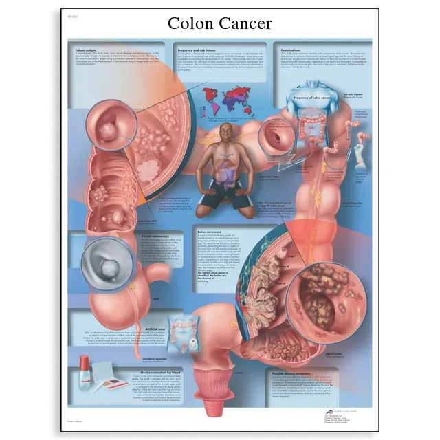 3b-scientific-lehrtafel-darmkrebs-diagramm-50x67-cm-anatomie-poster image 1