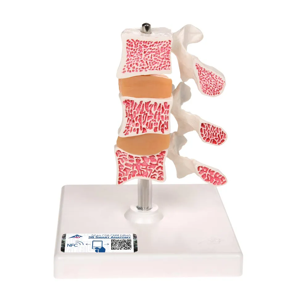 3b-scientific-osteoporose-modell-luxus-3-lendenwirbel-auf-stativ-mit-smart-anato image 1