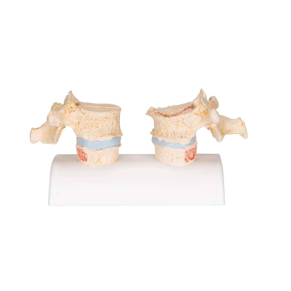 3b-scientific-osteoporosemodell-brustwirbel-vergleichsmodell-gesund-vs-osteoporo image 4