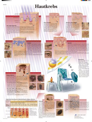 3b-scientific-lehrtafel-hautkrebs-laminiertes-anatomie-poster-50-x-67-cm image 2