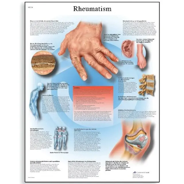 3b-scientific-lehrtafel-rheumatische-erkrankungen-laminiertes-poster-50-x-67-cm image 1