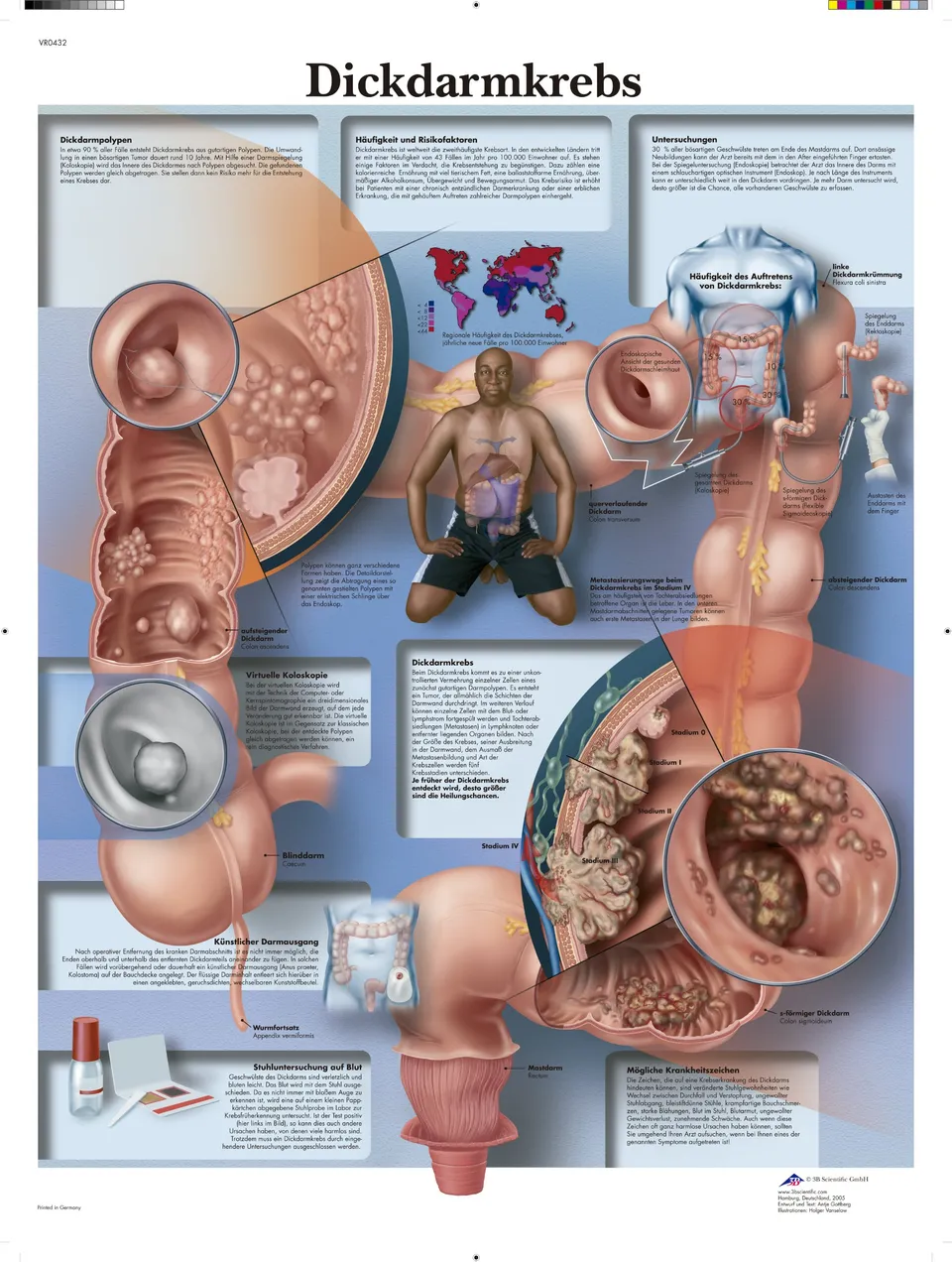 3b-scientific-lehrtafel-dickdarmkrebs-anatomie-poster-50-x-67-cm image 1