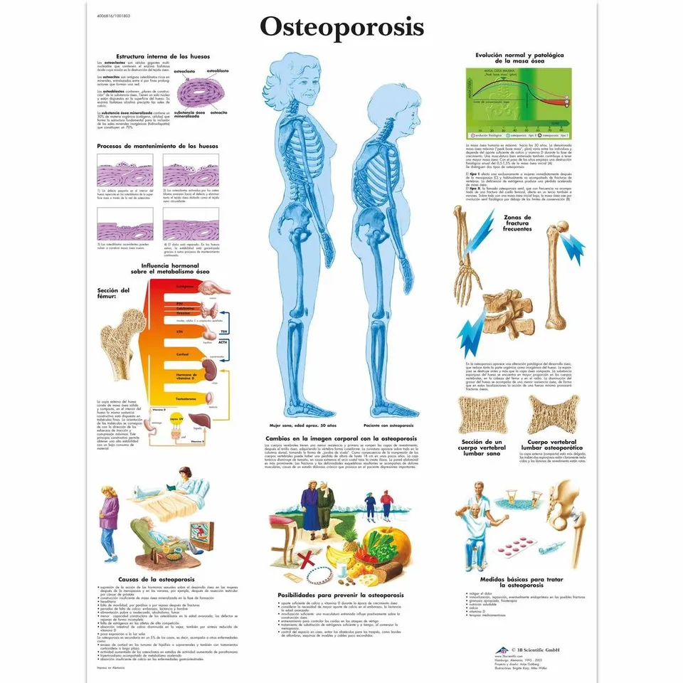 3b-scientific-osteoporose-lehrtafel-papier-50-x-67-cm image 1