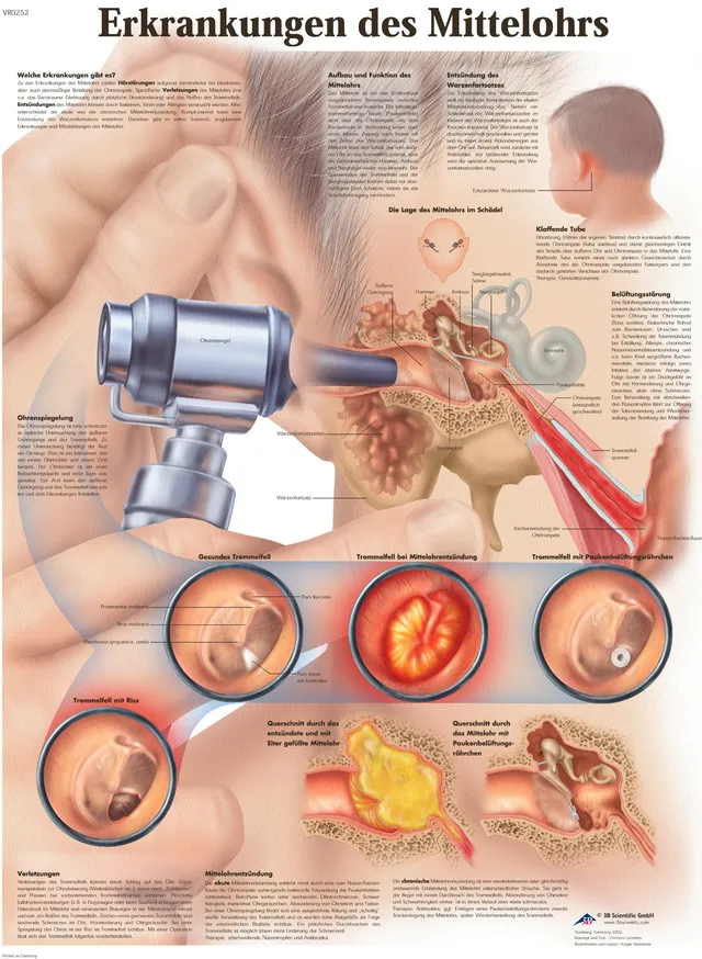 3b-scientific-lehrtafel-erkrankungen-des-mittelohrs-anatomie-poster-50x67-cm-unl image 1