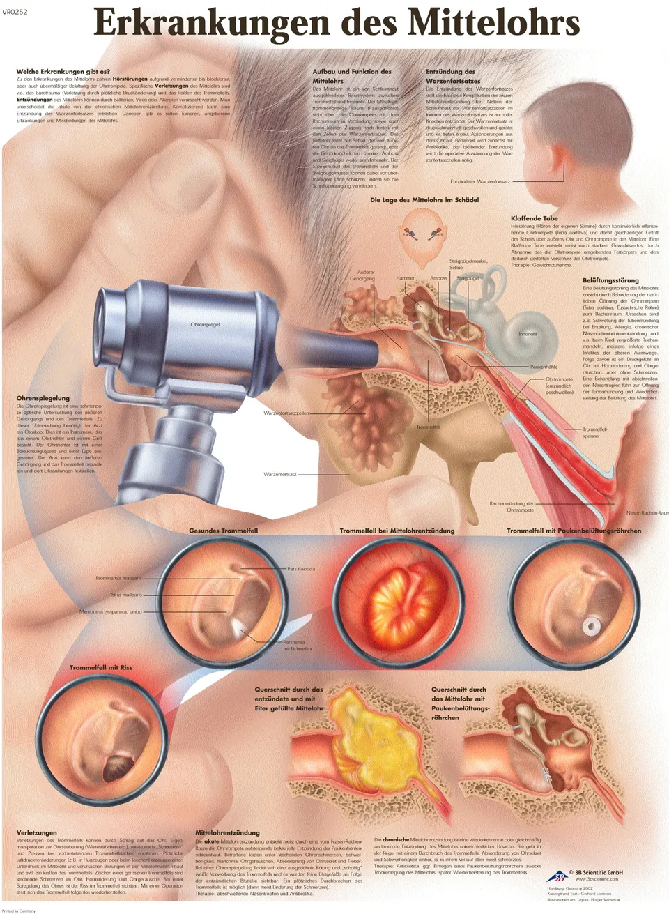 3b-scientific-lehrtafel-erkrankungen-des-mittelohrs-anatomie-poster-50x67-cm-unl image 1