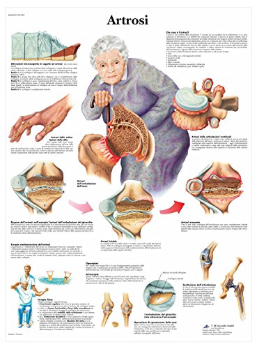 3b-scientific-vr4123l-lehrposter-arthrose image 4