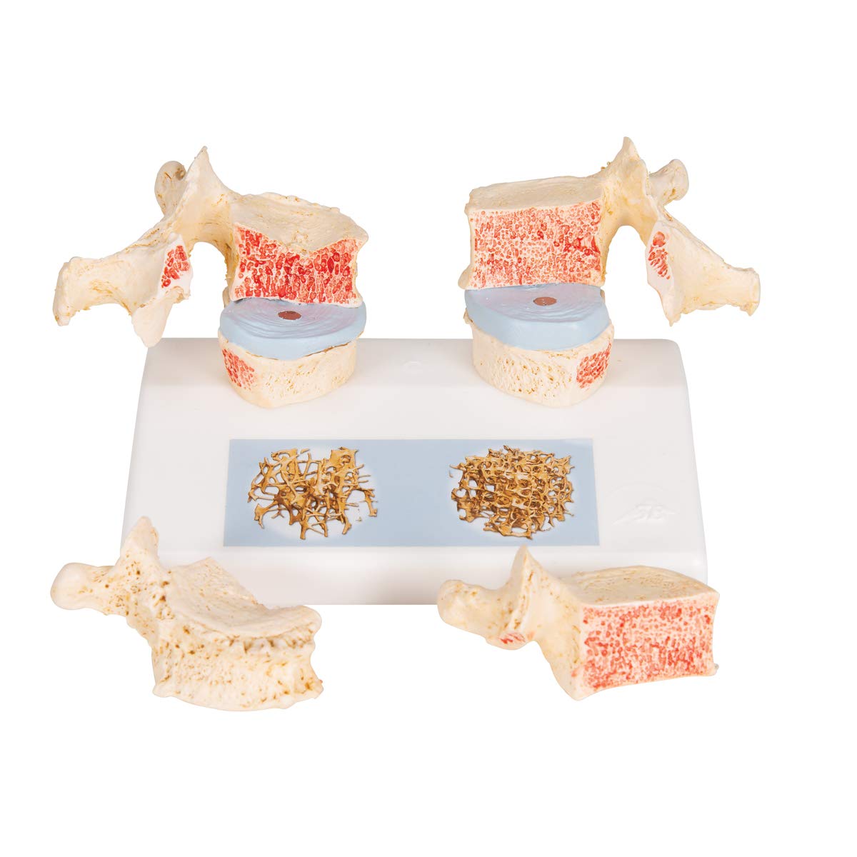 3b-scientific-osteoporosemodell-brustwirbel-vergleichsmodell-gesund-vs-osteoporo image 7