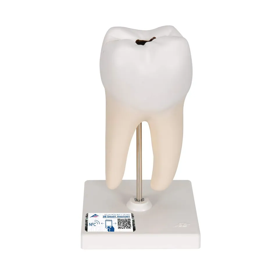 3b-scientific-unterer-molar-2-wurzelig-zahnmodell-mit-karies-2-teilig-app image 1