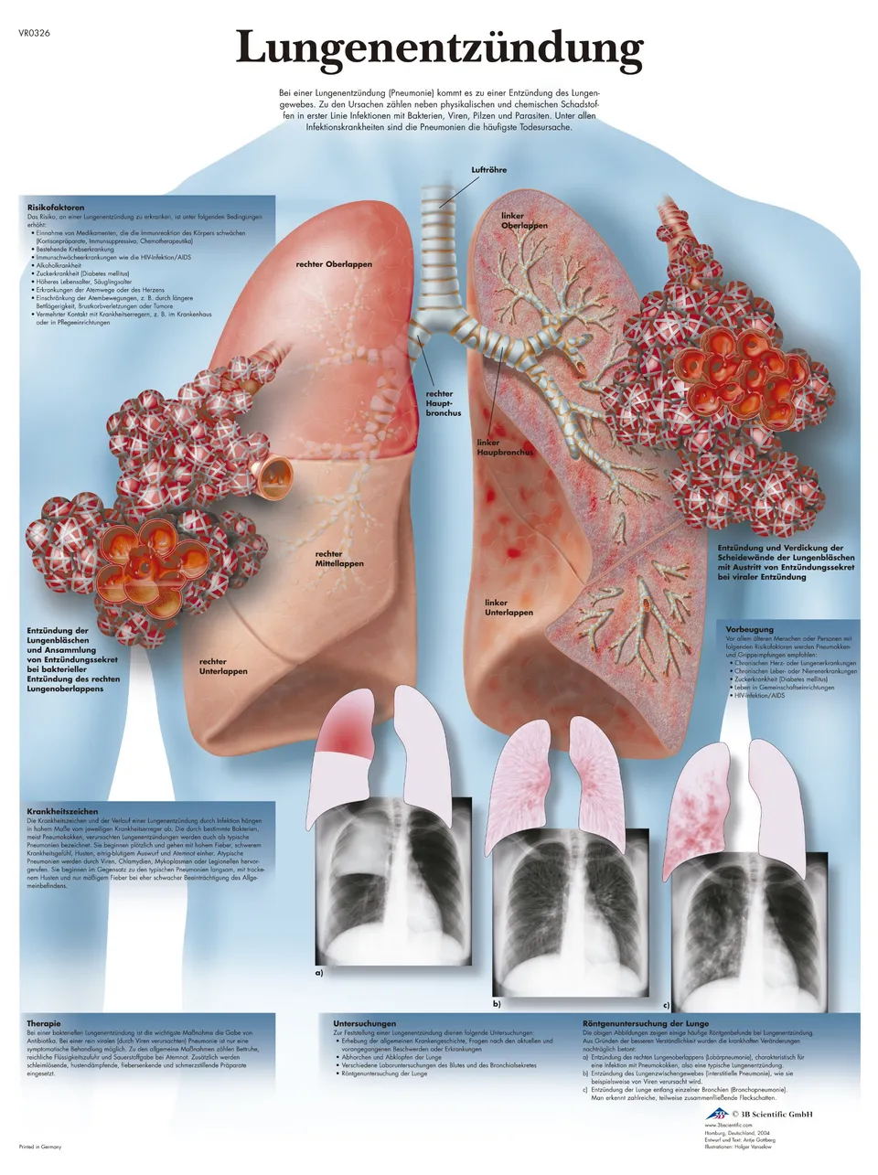 3b-scientific-lehrtafel-lungenentz-ndung-anatomie-poster-50-x-67-cm-unlaminiert image 1