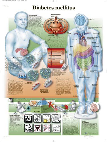 3b-scientific-lehrtafel-diabetes-mellitus-poster-50x67-cm image 2