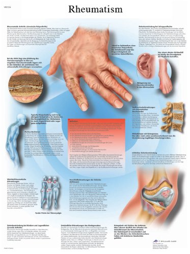 3b-scientific-lehrtafel-rheumatische-erkrankungen-laminiertes-poster-50-x-67-cm image 4