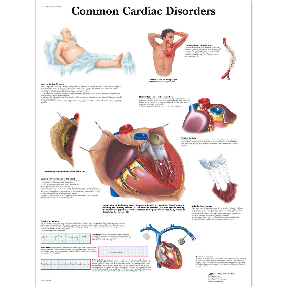 3b-scientific-lehrposter-h-ufige-herzerkrankungen-diagramm-poster-50-x-67-cm image 2
