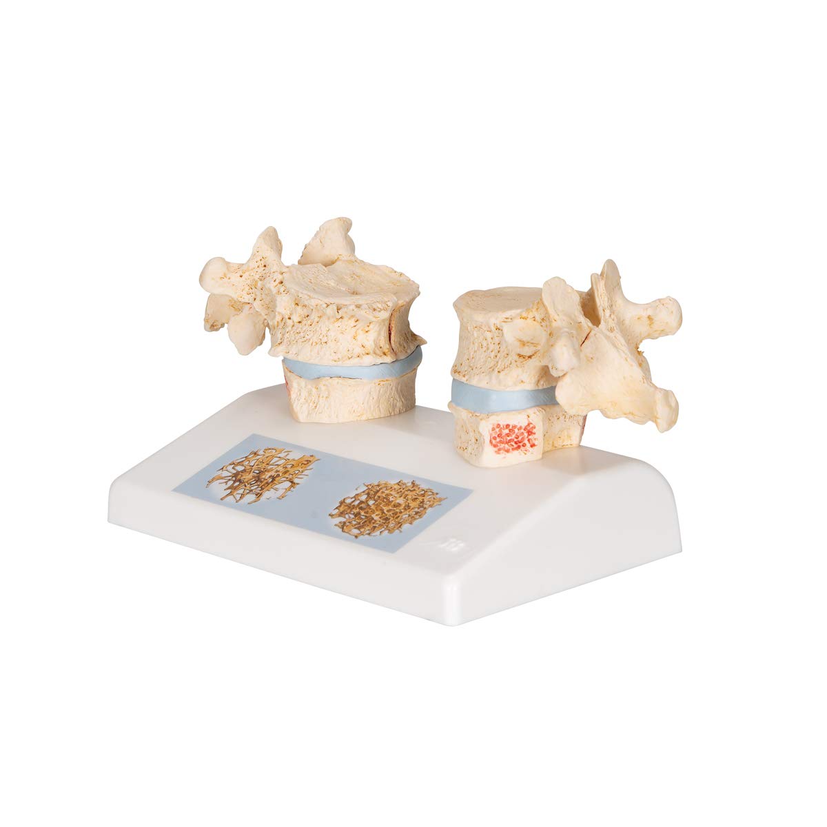 3b-scientific-osteoporosemodell-brustwirbel-vergleichsmodell-gesund-vs-osteoporo image 6