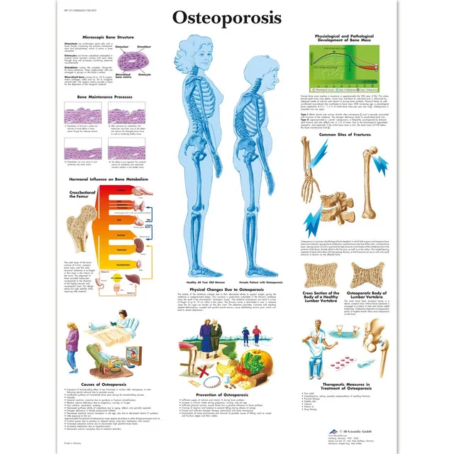 3b-scientific-osteoporose-diagramm-laminiert-50-8-x-66-cm-anatomie-lehrposter image 1