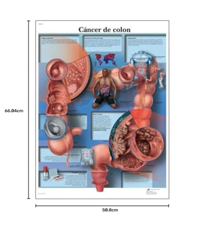 3b-scientific-lehrtafel-c-ncer-de-colon-spanisch-laminiertes-anatomie-poster-50- image 2