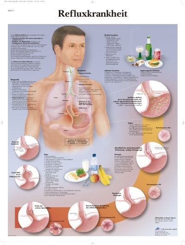 3b-scientific-lehrtafel-refluxkrankheit-anatomie-poster-50x67-cm image 2