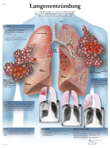 3b-scientific-lehrtafel-lungenentz-ndung-anatomie-poster-50-x-67-cm-unlaminiert image 2